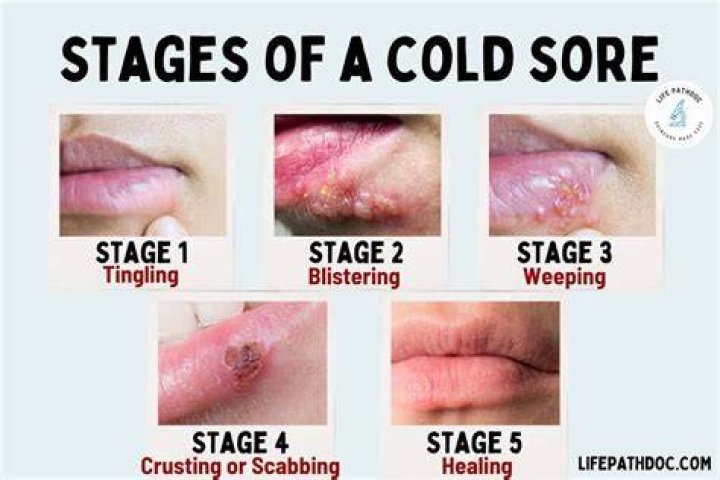Can You Pop a Cold Sore Safely? Everything You Need to Know