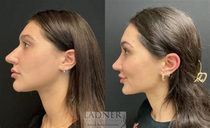 Dichen Lachman Nose: A Closer Look at the Iconic Feature