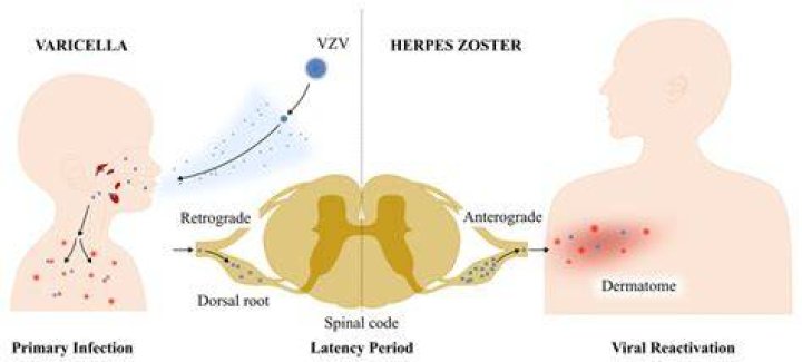 Exploring the Possibilities: Is a Herpes Cure Within Reach?