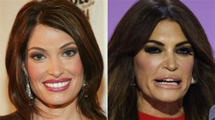 Kimberly Guilfoyle: Before and After Surgery - Transformation Revealed