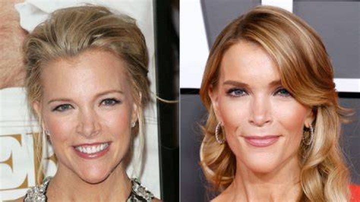 Megyn Kelly Plastic Surgery: Before & After Photos?