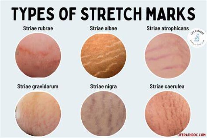 Understanding Stretch Marks and Muscle Growth: A Comprehensive Guide