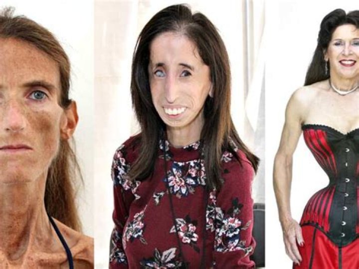 Who Was the Skinniest Person in the World? Unveiling the Remarkable Life of Lucia Zarate